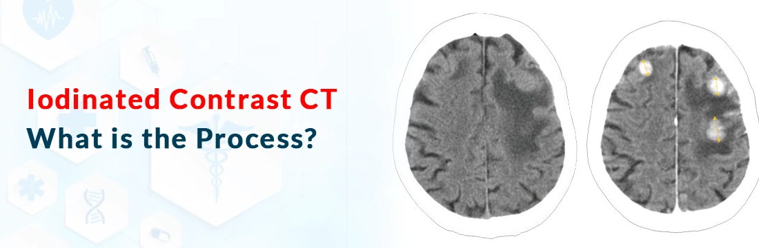  Iodinated Contrast CT: What is the Process?